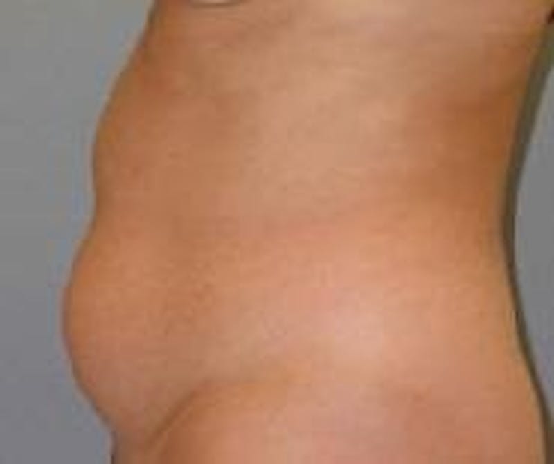 Liposuction Before & After Gallery - Patient 90402677 - Image 3