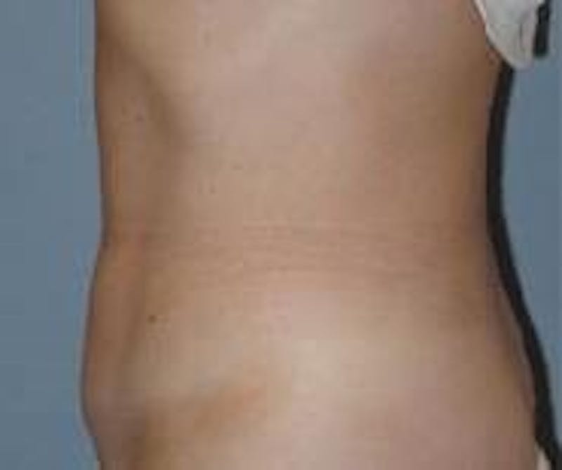 Liposuction Before & After Gallery - Patient 90402677 - Image 4