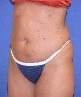 Liposuction Gallery - Patient 90402685 - Image 1