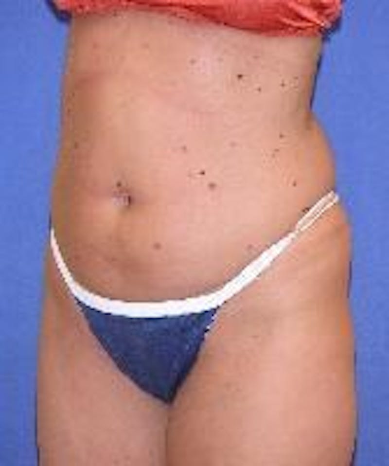 Liposuction Before & After Gallery - Patient 90402685 - Image 1