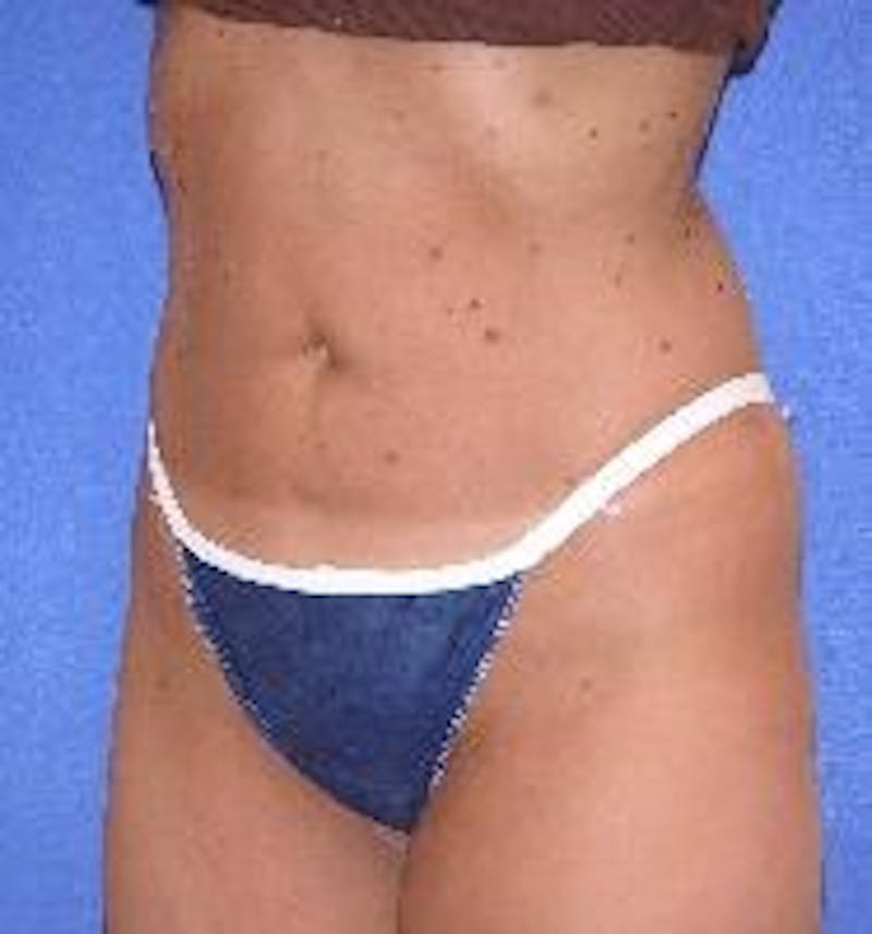 Liposuction Gallery - Patient 90402685 - Image 2