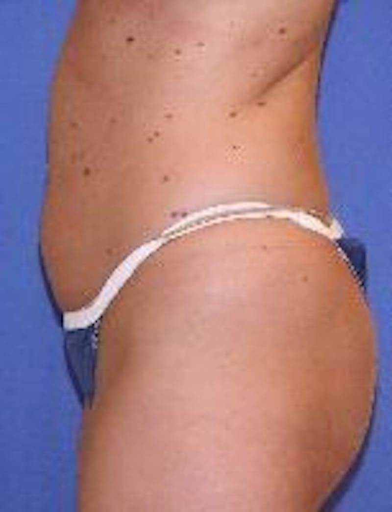Liposuction Before & After Gallery - Patient 90402685 - Image 3