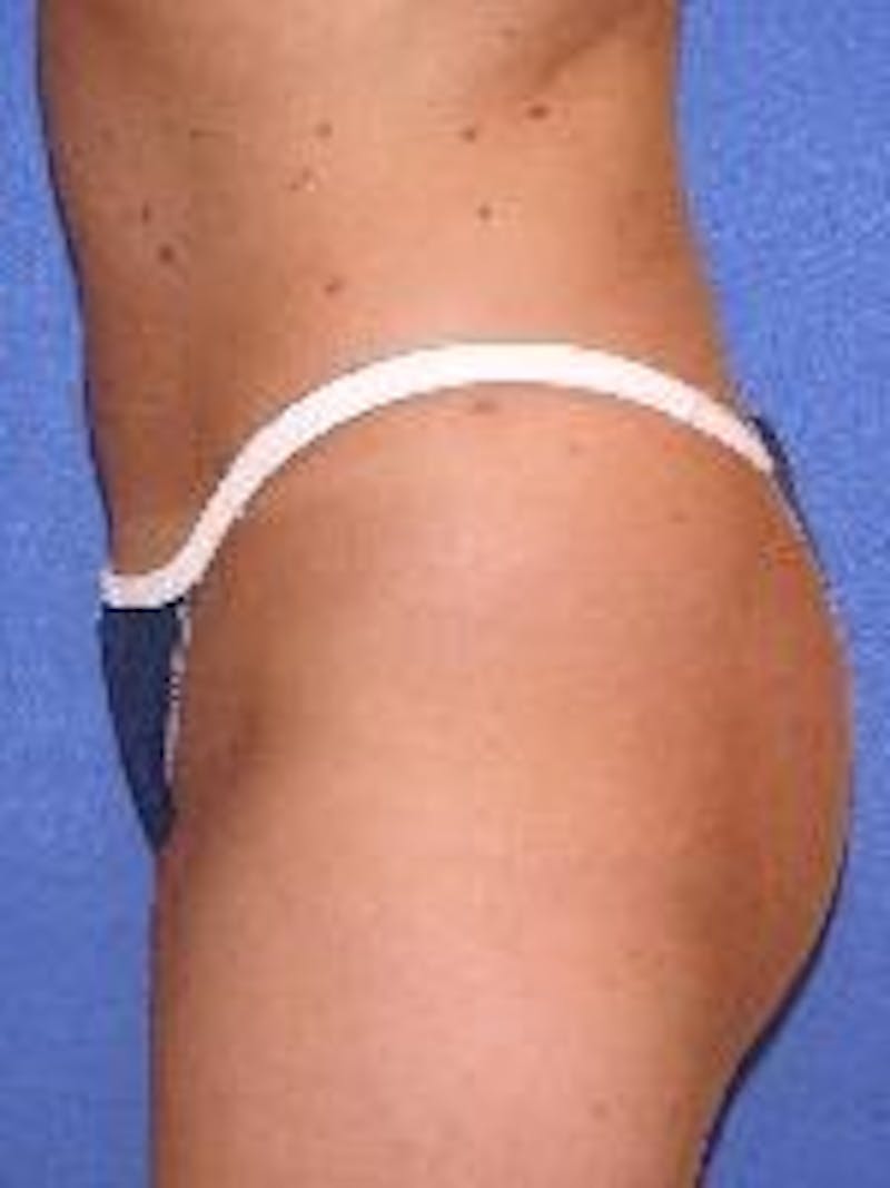 Liposuction Gallery - Patient 90402685 - Image 4