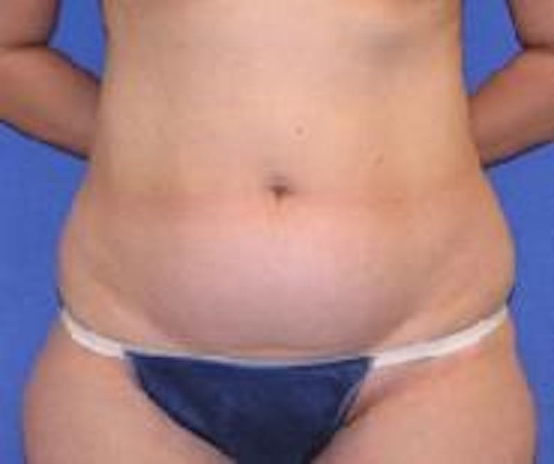 Liposuction Before & After Gallery - Patient 90402688 - Image 1