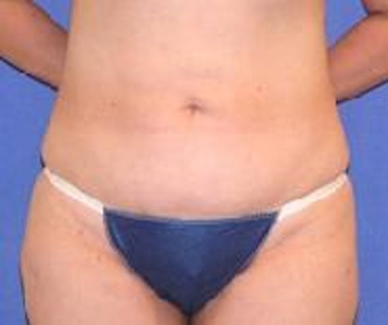 Liposuction Before & After Gallery - Patient 90402688 - Image 2