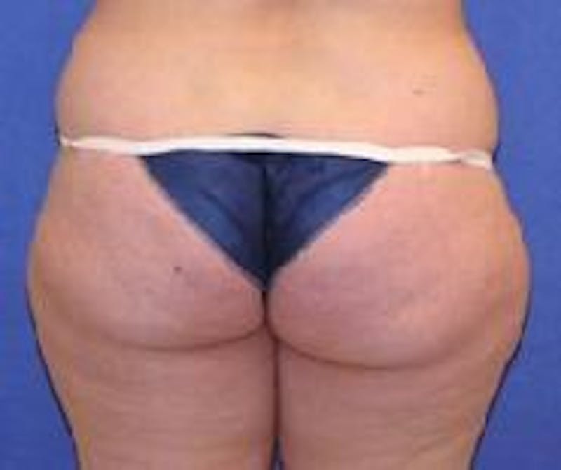 Liposuction Before & After Gallery - Patient 90402688 - Image 3