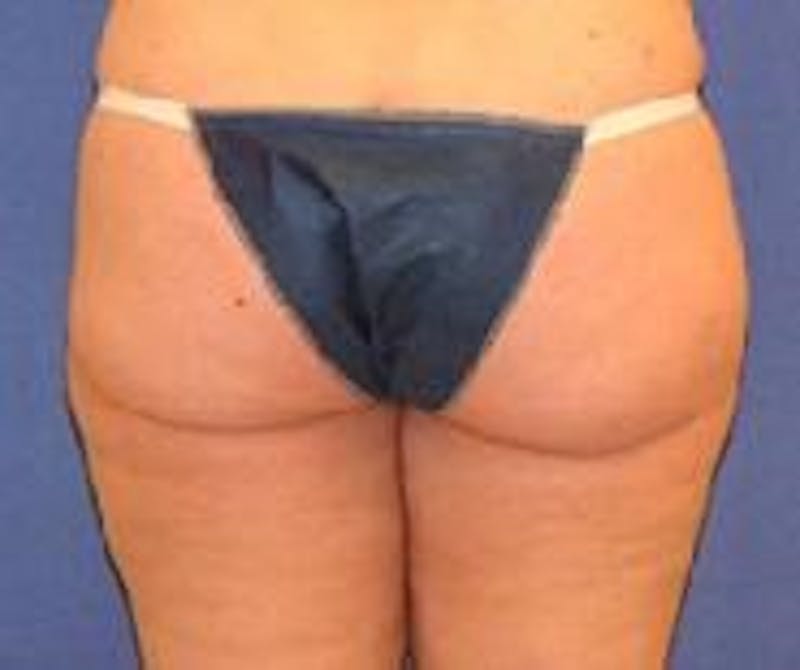 Liposuction Before & After Gallery - Patient 90402688 - Image 4