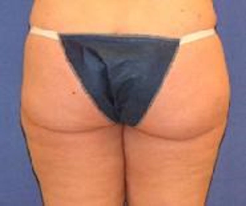 Liposuction Before & After Gallery - Patient 90402688 - Image 4
