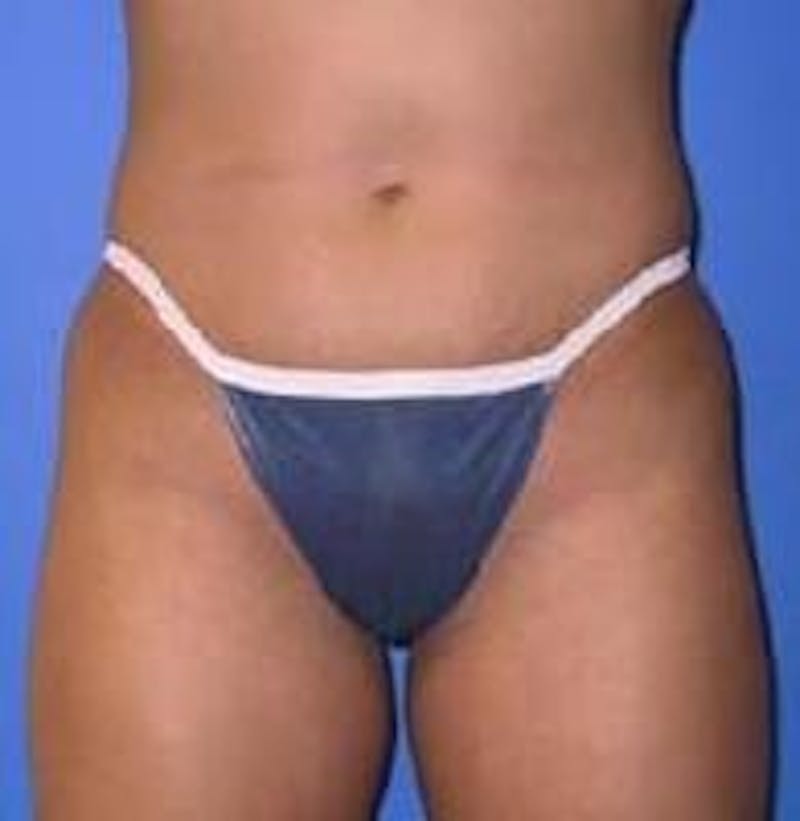 Liposuction Before & After Gallery - Patient 90402691 - Image 1
