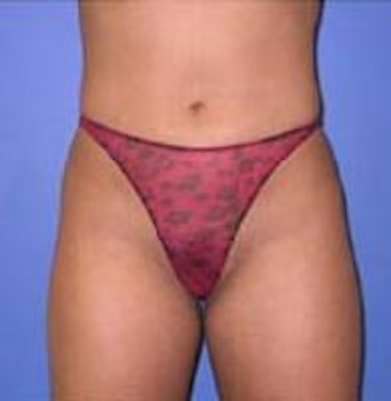 Liposuction Before & After Gallery - Patient 90402691 - Image 2