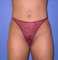 Liposuction Gallery - Patient 90402691 - Image 2
