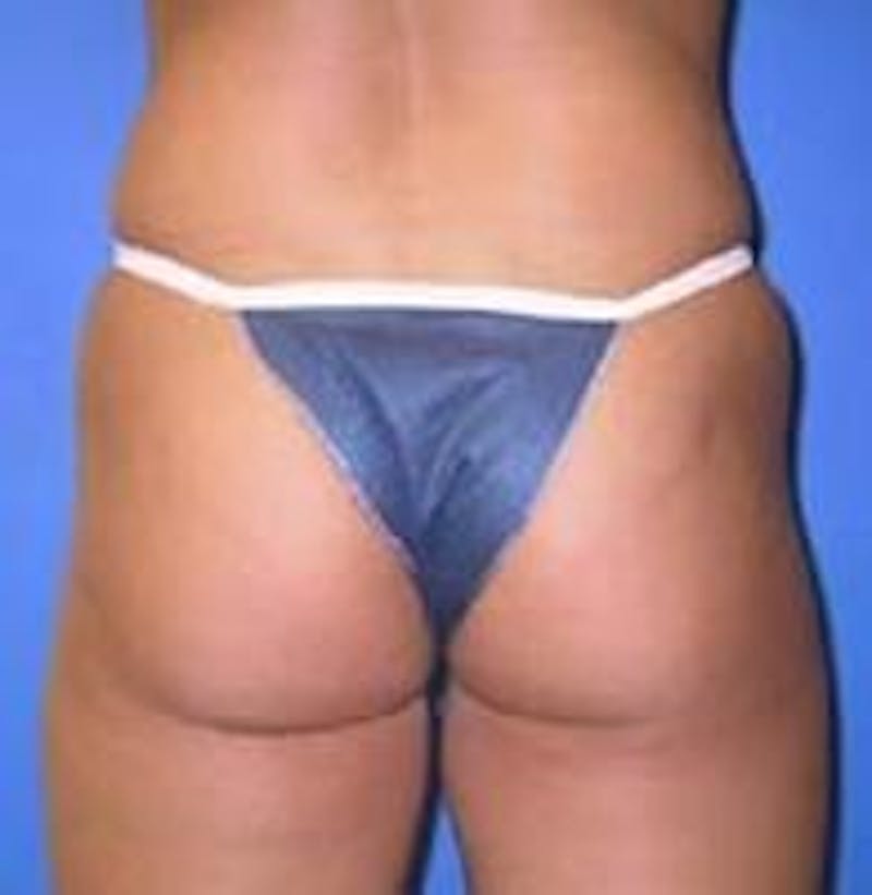 Liposuction Before & After Gallery - Patient 90402691 - Image 3