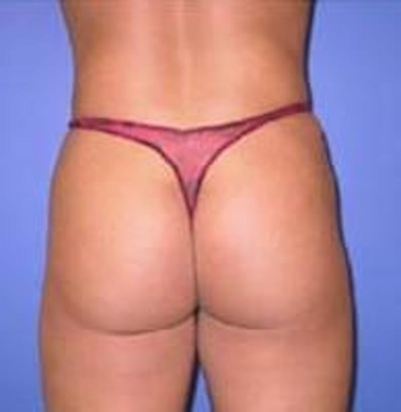 Liposuction Before & After Gallery - Patient 90402691 - Image 4