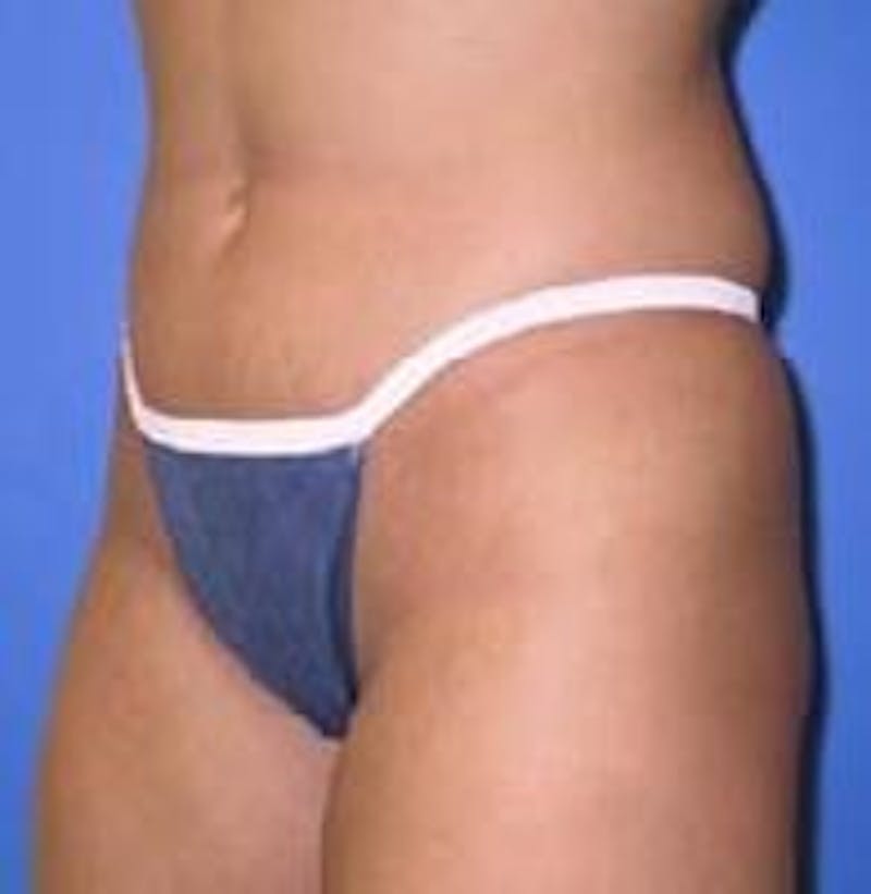 Liposuction Before & After Gallery - Patient 90402691 - Image 5