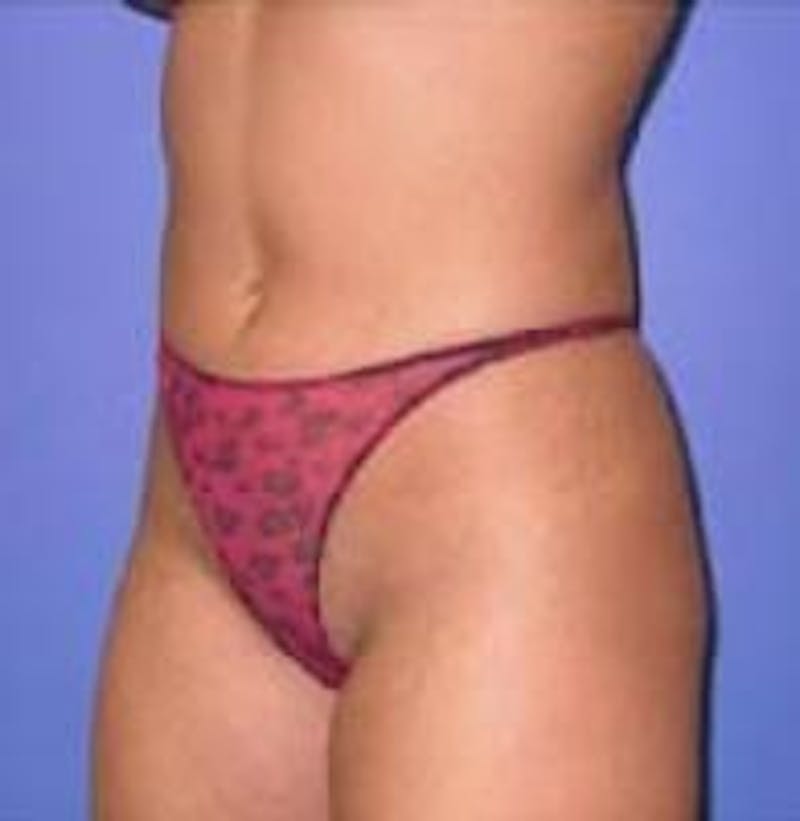 Liposuction Before & After Gallery - Patient 90402691 - Image 6