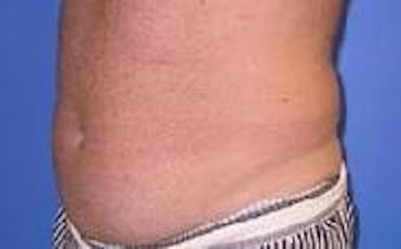 Liposuction Before & After Gallery - Patient 90402695 - Image 3