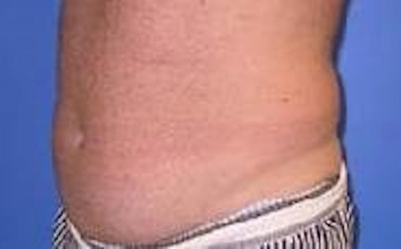 Liposuction Before & After Gallery - Patient 90402695 - Image 3