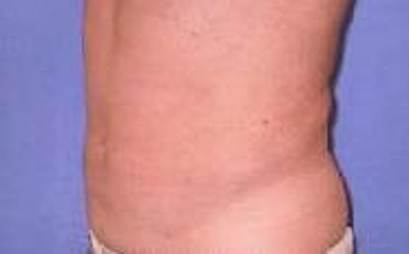 Liposuction Before & After Gallery - Patient 90402695 - Image 4