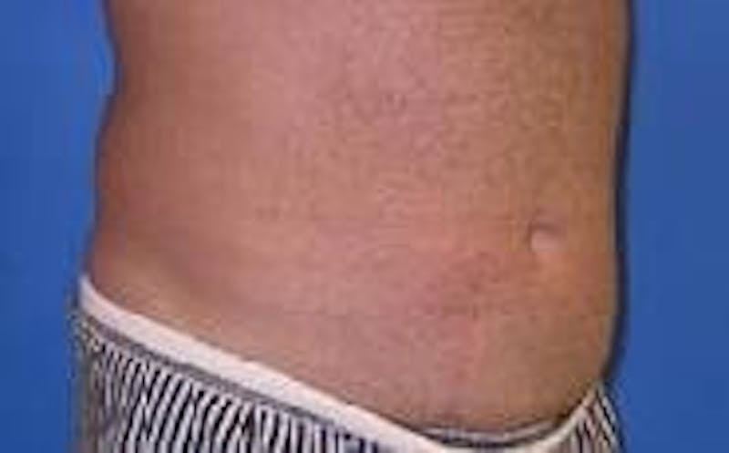 Liposuction Before & After Gallery - Patient 90402695 - Image 5