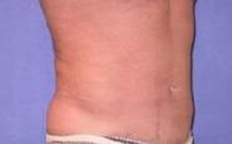 Liposuction Before & After Gallery - Patient 90402695 - Image 6