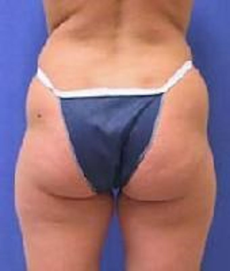 Liposuction Before & After Gallery - Patient 90402697 - Image 1
