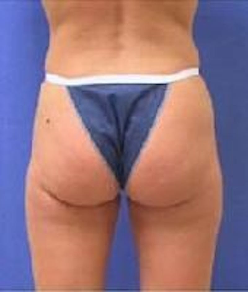 Liposuction Before & After Gallery - Patient 90402697 - Image 2