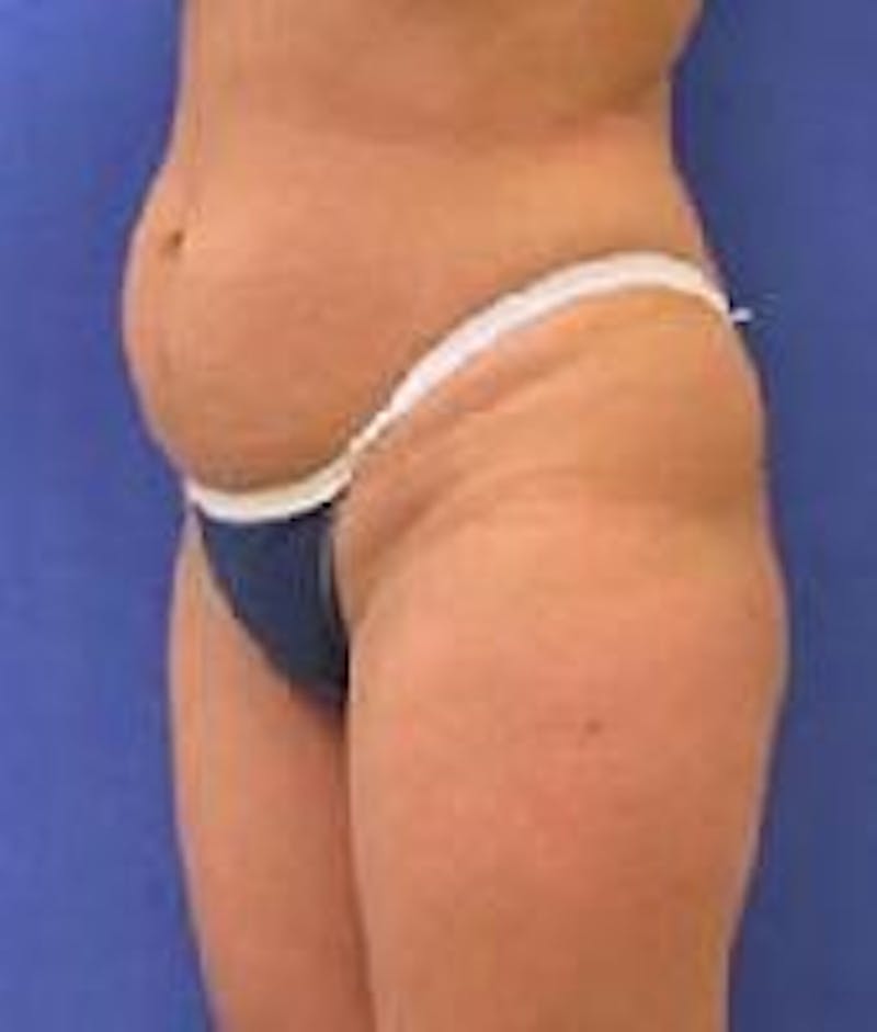 Liposuction Before & After Gallery - Patient 90402697 - Image 3