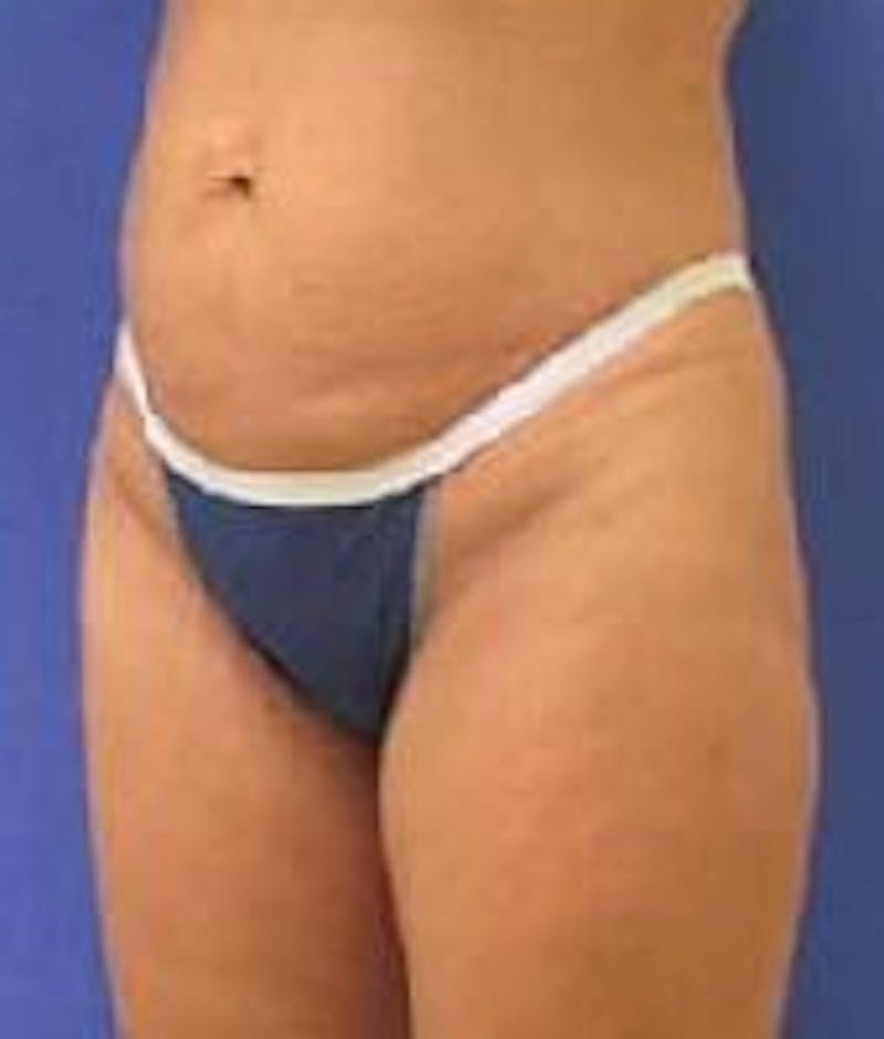Liposuction Before & After Gallery - Patient 90402697 - Image 4