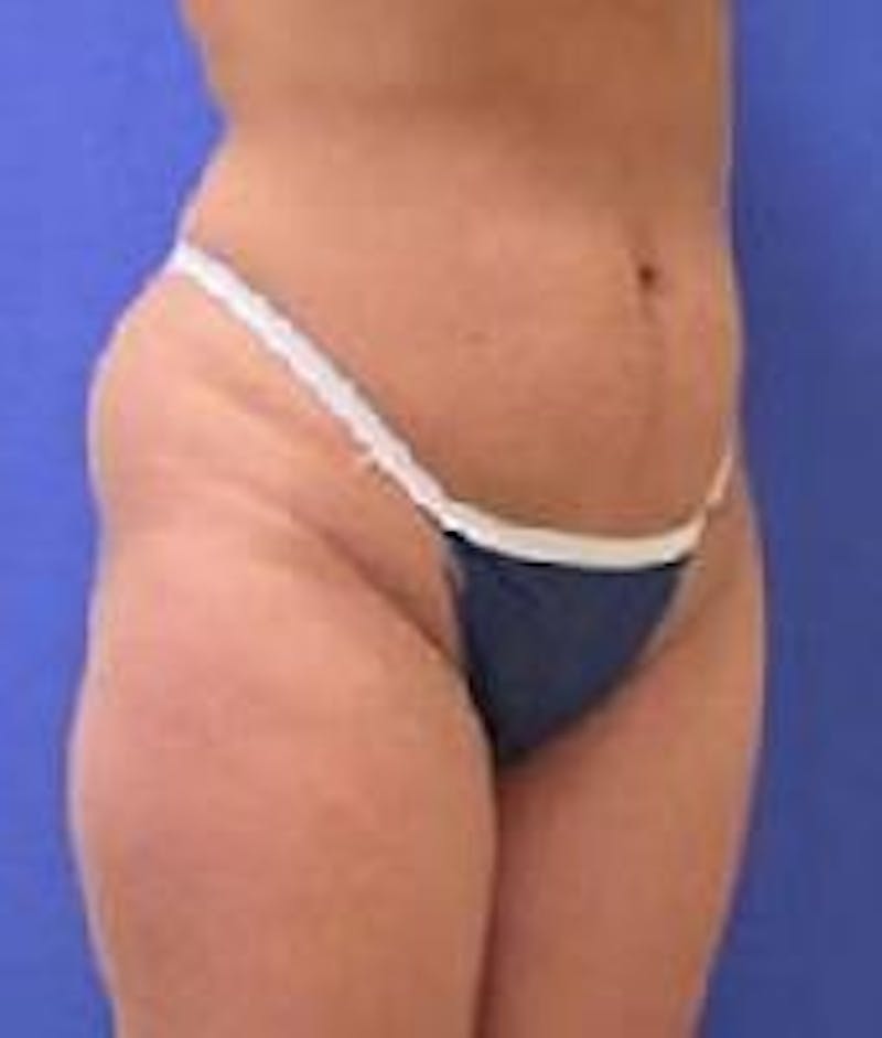 Liposuction Before & After Gallery - Patient 90402697 - Image 5