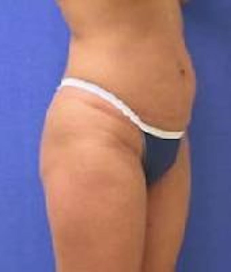 Liposuction Before & After Gallery - Patient 90402697 - Image 6