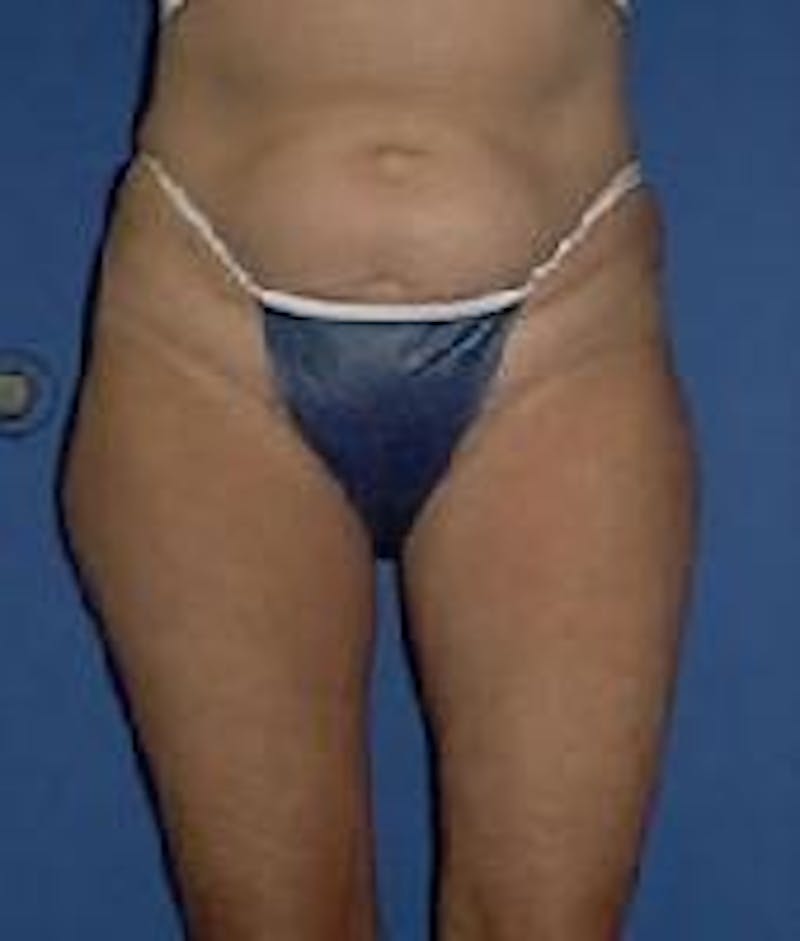 Liposuction Before & After Gallery - Patient 90402698 - Image 1