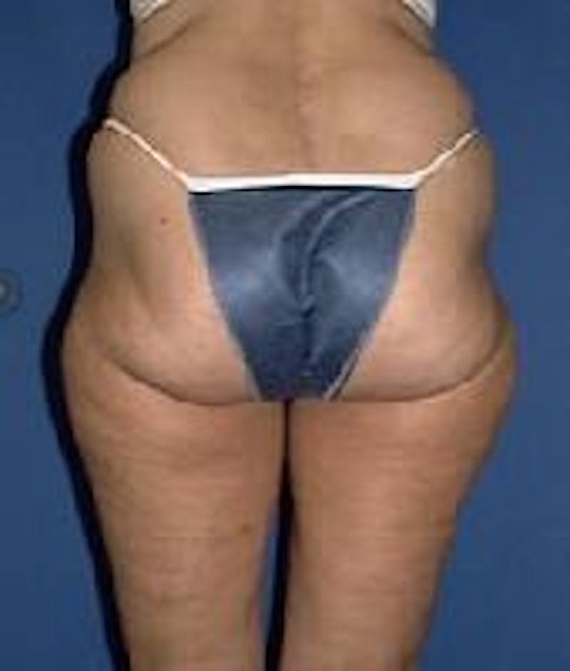 Liposuction Before & After Gallery - Patient 90402698 - Image 3