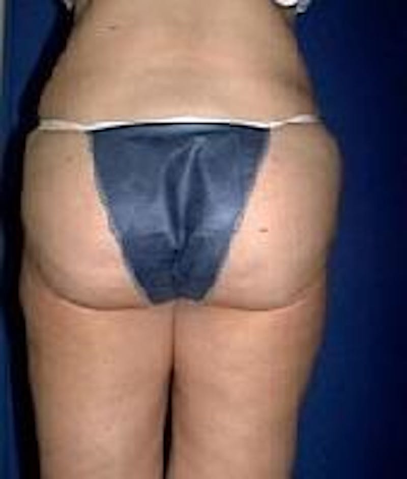 Liposuction Before & After Gallery - Patient 90402702 - Image 2