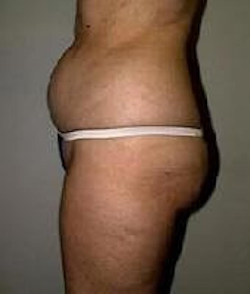 Liposuction Before & After Gallery - Patient 90402702 - Image 3