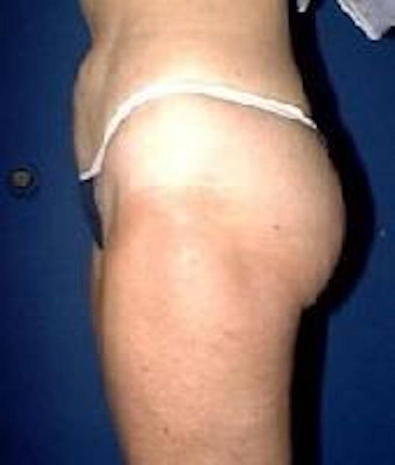 Liposuction Before & After Gallery - Patient 90402702 - Image 4
