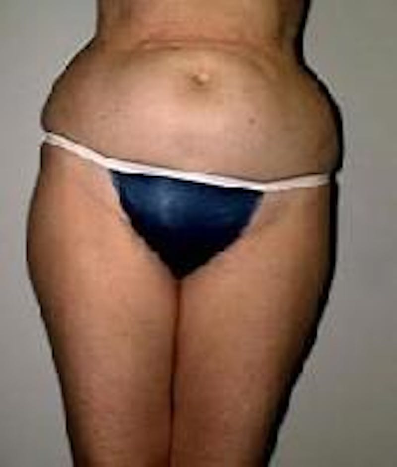 Liposuction Before & After Gallery - Patient 90402702 - Image 5