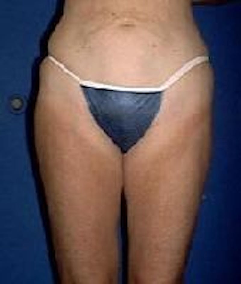 Liposuction Before & After Gallery - Patient 90402702 - Image 6