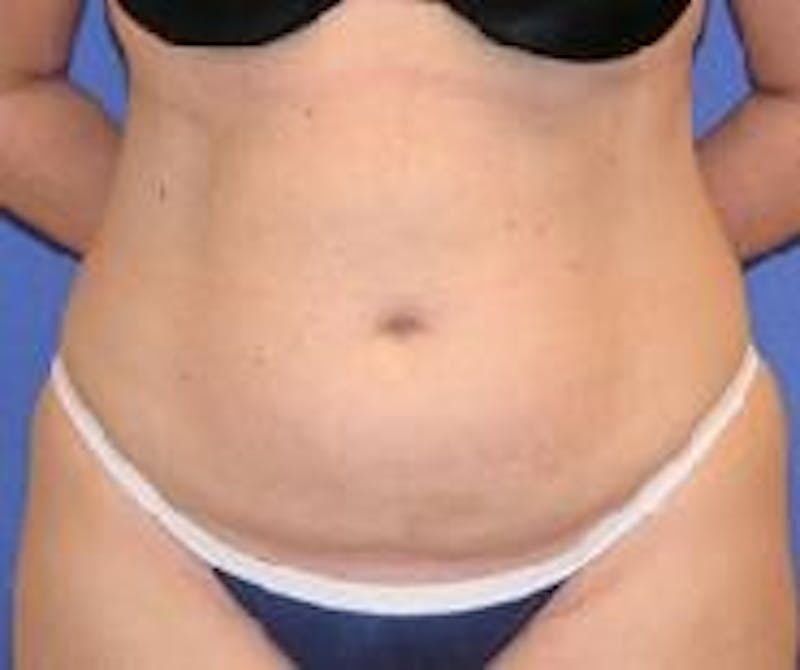 Liposuction Before & After Gallery - Patient 90404959 - Image 1