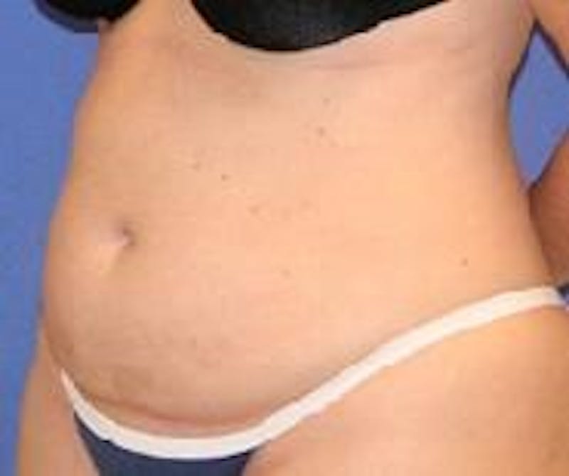 Liposuction Before & After Gallery - Patient 90404959 - Image 3