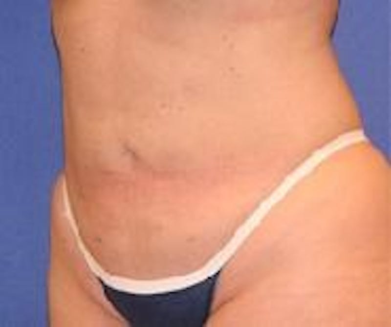 Liposuction Before & After Gallery - Patient 90404959 - Image 4