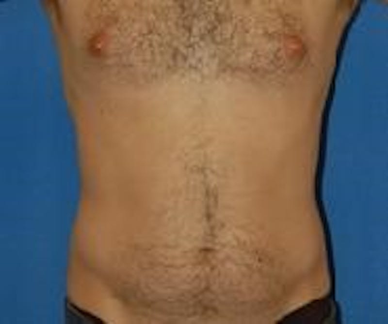 Liposuction Before & After Gallery - Patient 90404960 - Image 1