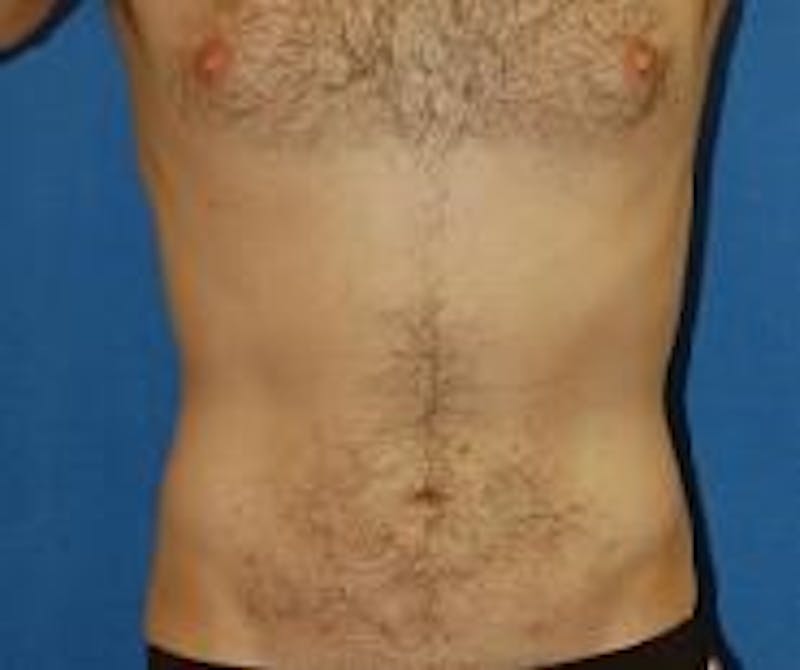 Liposuction Before & After Gallery - Patient 90404960 - Image 2
