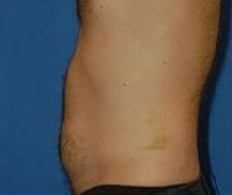 Liposuction Before & After Gallery - Patient 90404960 - Image 3
