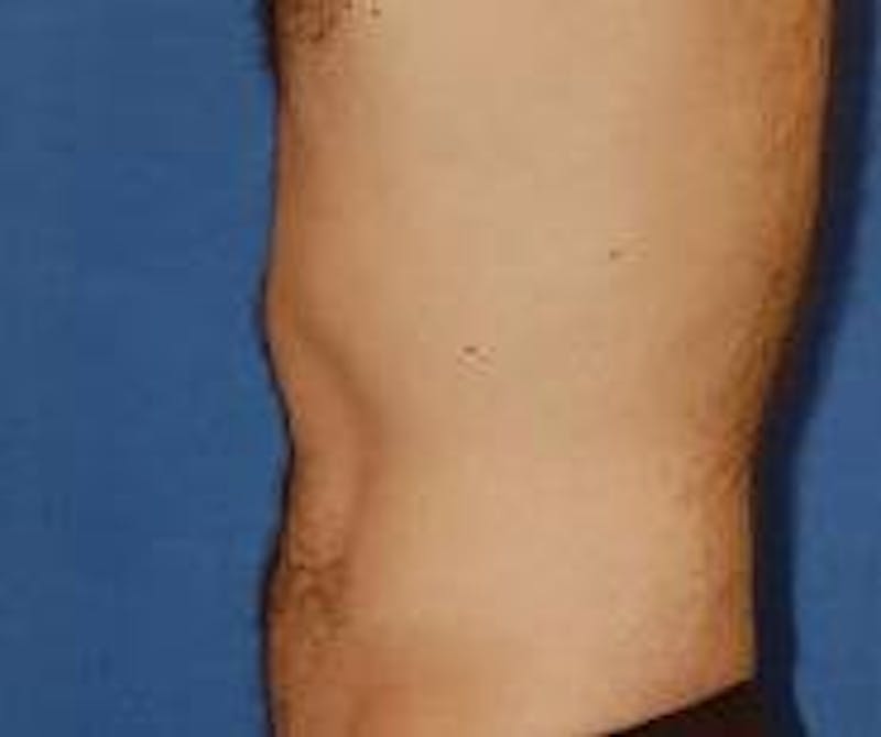 Liposuction Before & After Gallery - Patient 90404960 - Image 4