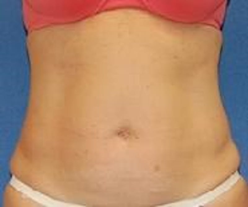 Liposuction Gallery - Patient 90404963 - Image 1