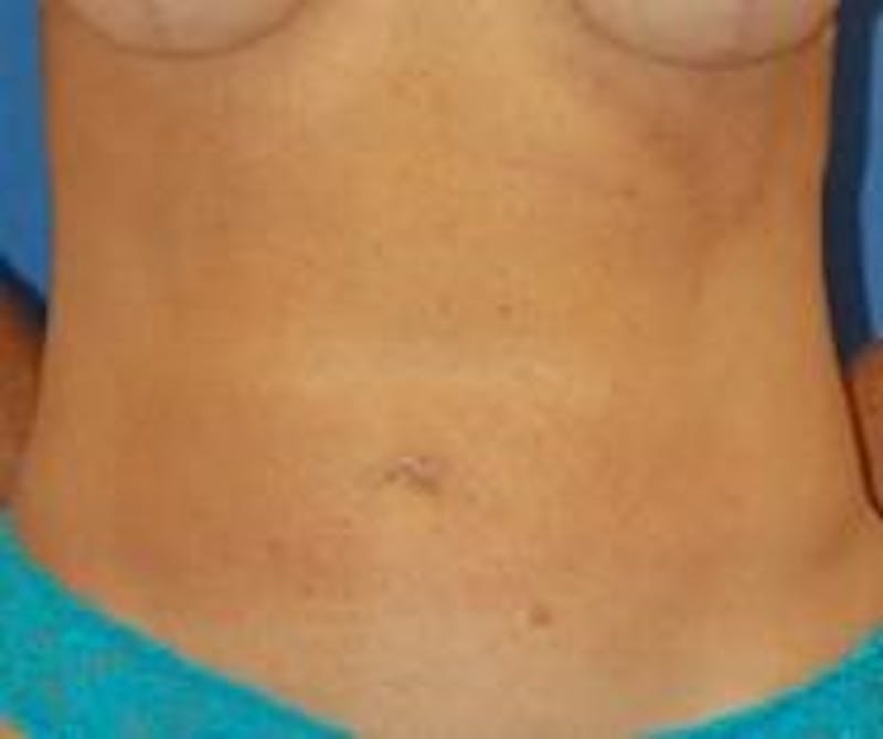 Liposuction Gallery - Patient 90404963 - Image 2