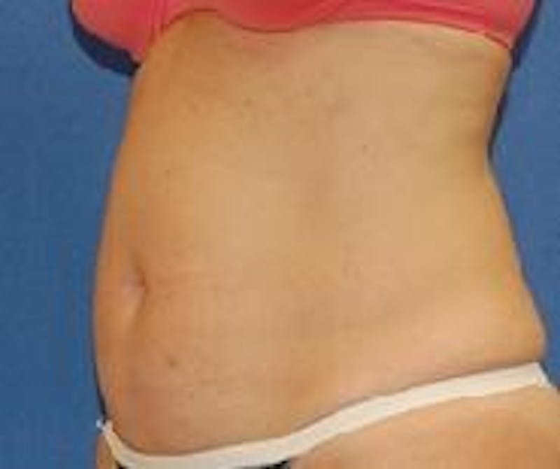 Liposuction Before & After Gallery - Patient 90404963 - Image 3