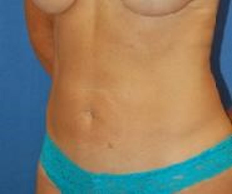 Liposuction Gallery - Patient 90404963 - Image 4