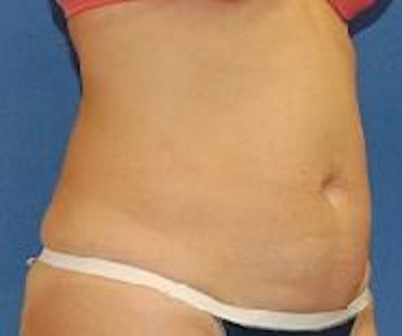 Liposuction Before & After Gallery - Patient 90404963 - Image 5