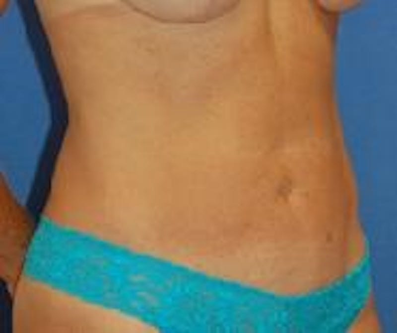 Liposuction Gallery - Patient 90404963 - Image 6